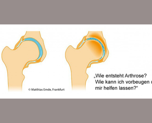 Wie entsteht Arthrose